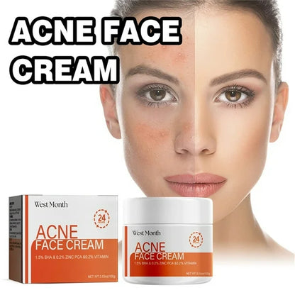 Crema para quitar el acné y las marcas