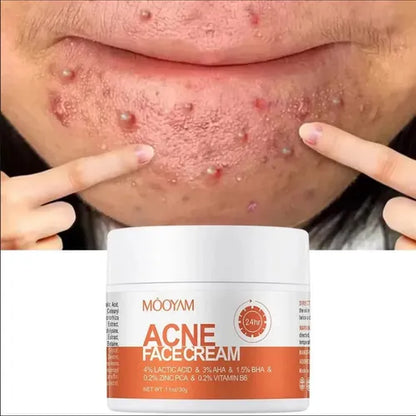 Crema para quitar el acné y las marcas
