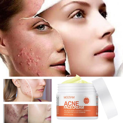 Crema para quitar el acné y las marcas